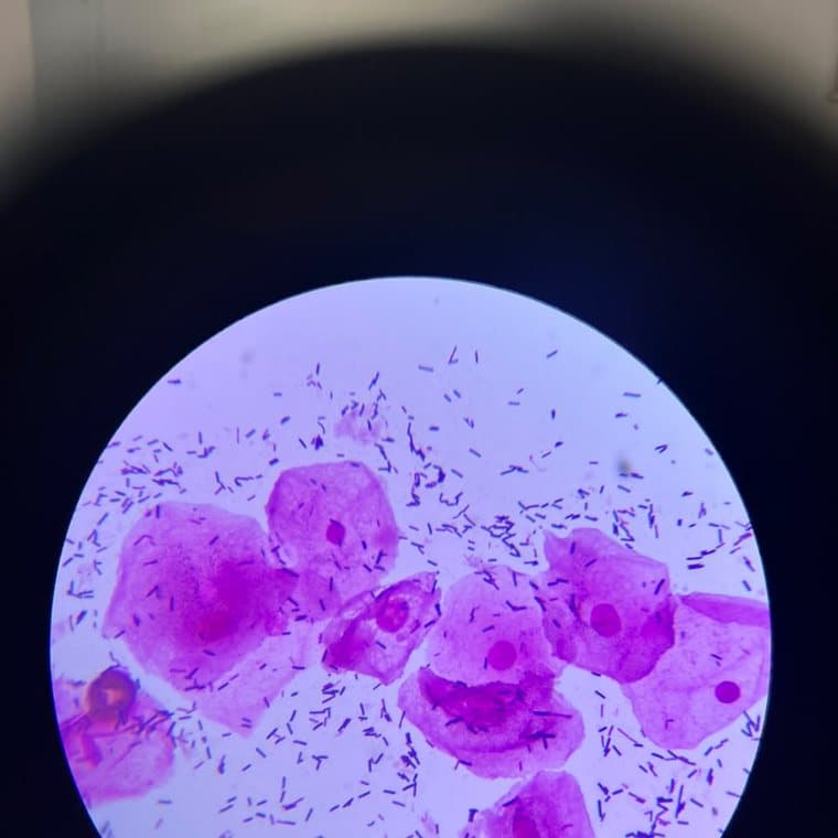 Lâmina de conteúdo vaginal corada mostrando alteração da flora